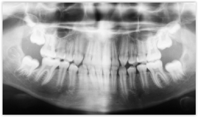 Panoramic X-Ray